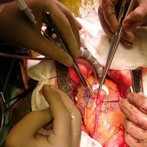 Beating heart bypass surgery
