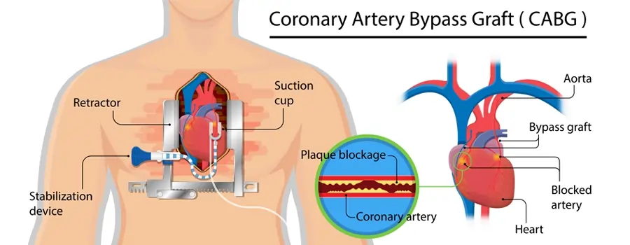 coronary artery bypass graft