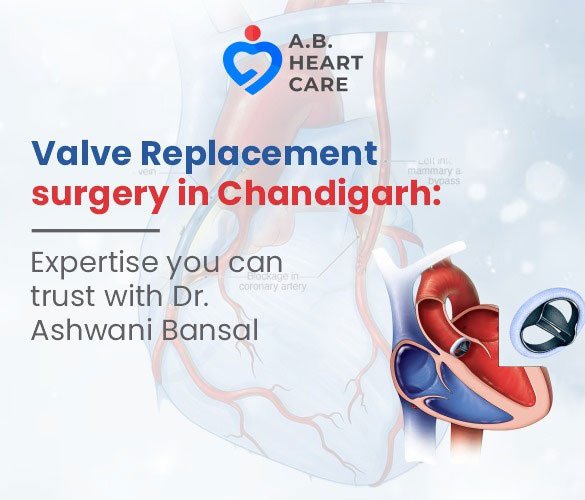 Valve Replacement Surgery: Expertise You Can Trust with Dr. Ashwani Bansal