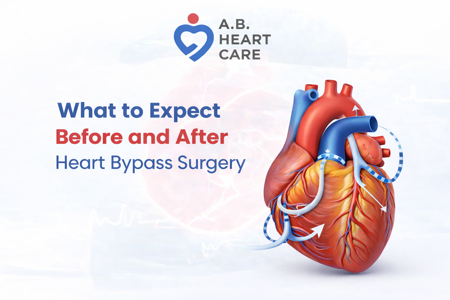 What to Expect Before and After Heart Bypass Surgery